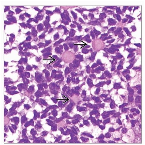 Granulosa Cell Tumor | Basicmedical Key