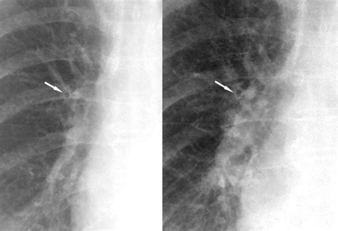 Peribronchial Thickening Cxr