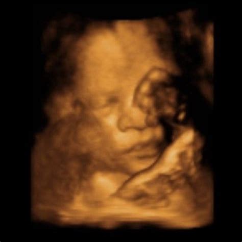 Growth Scan Any Guesses June 2024 Babies Forums What To Expect