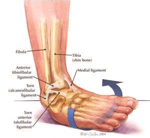 Try Mobilization With Movement For Chronic Ankle Pain Bolton Hill