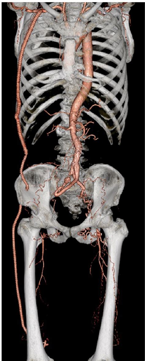 Right Axillopopliteal Artery Bypass Using A Combined Transiliac And Lateral Popliteal Approach