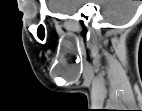 Ameloblastoma Image