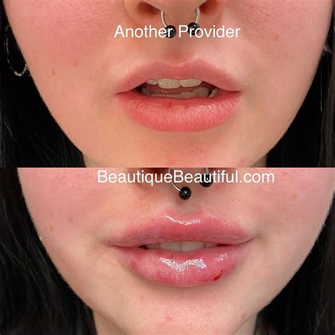 Best Lips In Knoxville Tn Beautique Medical Anti Aging