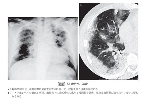 器質化肺炎について│不識庵 万年研修医のブログ