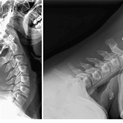 Cervical Herniated Disc X Ray