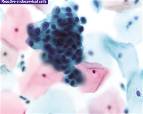 Atypical Glandular Cells Agc Cytology Of Glandular Lesions Of The