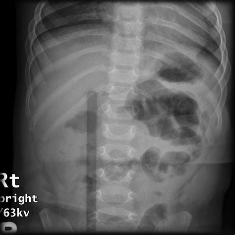 Intussusception Image