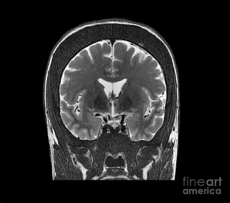 Thickened Skull, Mri Scan Photograph by Zephyr