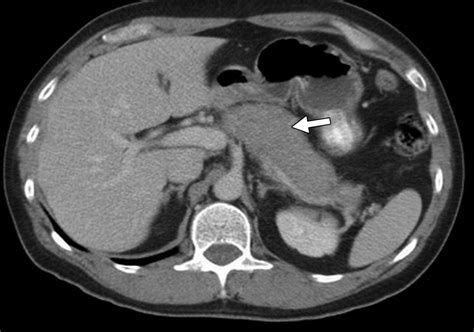 The Spectrum Of Igg Related Disease In The Abdomen And Pelvis Ajr