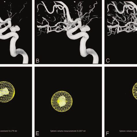 3D angiographic image of a posterior communicating artery aneurysm in 3 ...