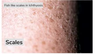 Ichthyosis Vulgaris Types Causes Symptoms Diagnosis Treatment