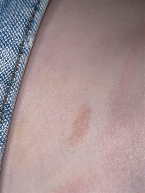 Dry Itchy Patch On Waist R Dermatologyquestions