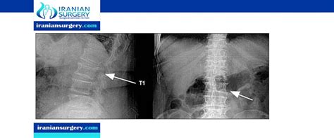 Vertebral compression fracture treatment in elderly | Iranian Surgery