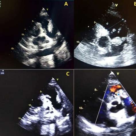 Pdf Adult Patent Ductus Arteriosus Complicated By Pulmonary Infective Endocarditis