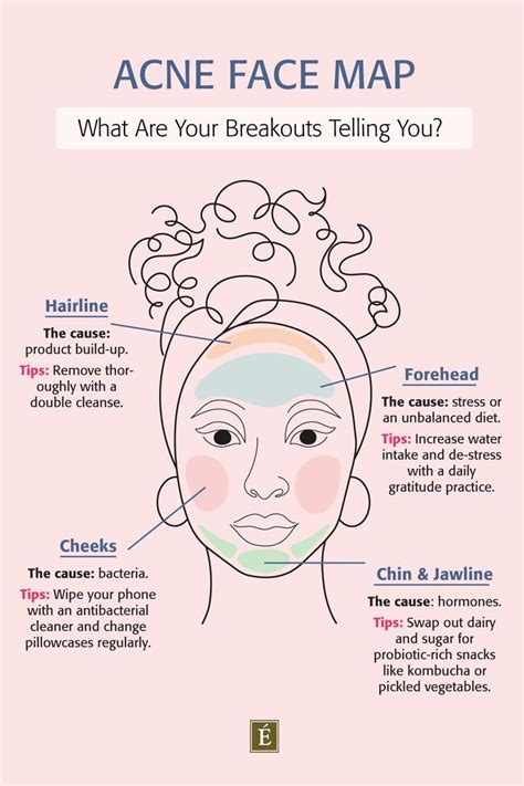 Acne Face Map What Are Your Breakouts Telling You Face Acne Face