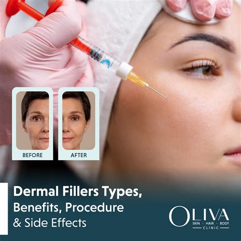 Dermal Fillers Types Benefits Procedure Cost And Side Effects