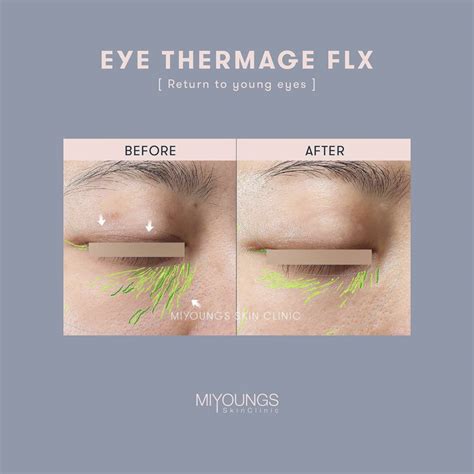 eye thermage miyoungs