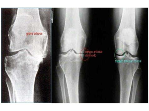 Gonartrose Descubra Em Que Casos A Prótese De Joelho Pode Ser Uma
