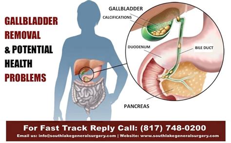 Gallbladder Removal And Gallbladder Laparoscopic Surgery Southlake Texas Gallbladder Surgery