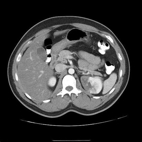 Renal Infarct Ct Wikidoc