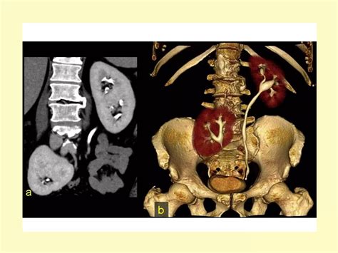 Congenital Anomalies Radiology Ppt