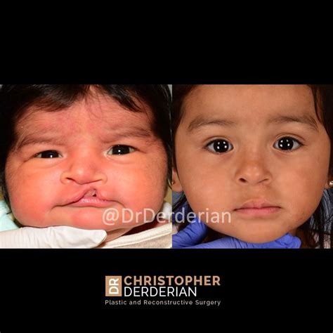 Cleft Palate Surgery & Cleft Lip Repair Near Me Dallas, Texas - Dr ...