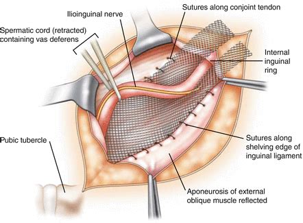 Inguinal Hernia Repair | Basicmedical Key