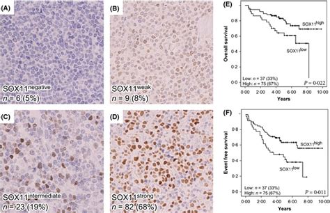 Representative Immunostaining Of SOX11 And Correlation To Overall