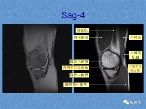 膝关节mri高清解剖图解，值得收藏！ 好医术文章 好医术 赋能医生守护生命