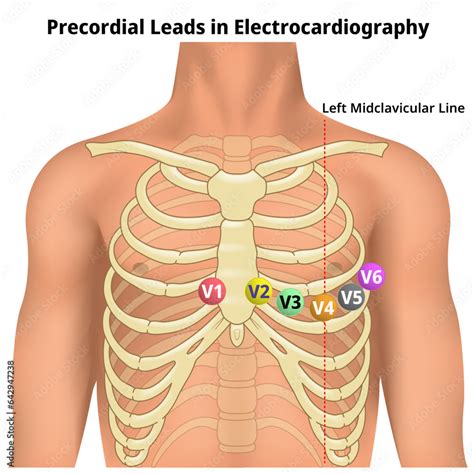 Precordial Leads In Electrocardiography V1 V2 V3 V4 V5 And V6