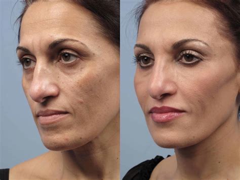 Toronto Fractional Erbium Laser Laser Skin Resurfacing