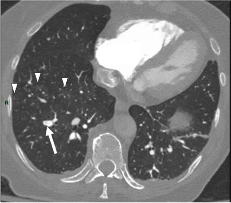 Ct Pulmonary Angiography Showing A Small Pulmonary Embolism In A Download Scientific Diagram