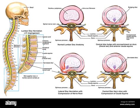 Disc Herniation Nerve Root Hi Res Stock Photography And Images Alamy