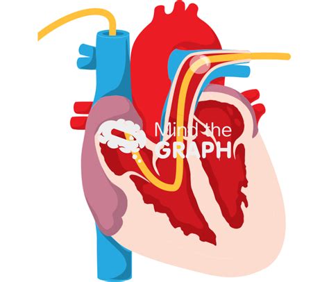 Swan Ganz Catheter Pulmonary Arthery