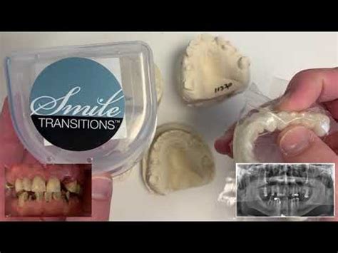 Instant Smile Transformation Smile Transitions Review YouTube