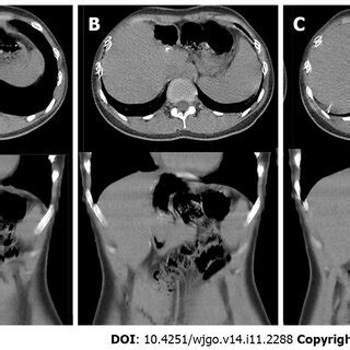 Abdominal Computed Tomography After 6 Mo Of Follow Up A After 6 Mo Of