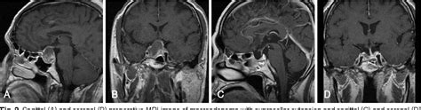 Figure 1 From Endoscopic Endonasal Transsphenoidal Skull Base Surgery