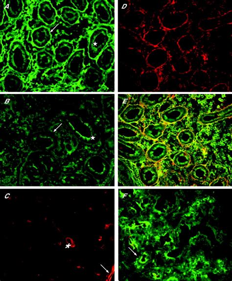 Endomysial Antibody Negative Coeliac Disease Clinical Characteristics