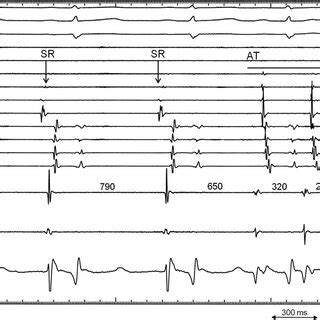 Body Surface Electrocardiograms And Intracardiac Electrograms In