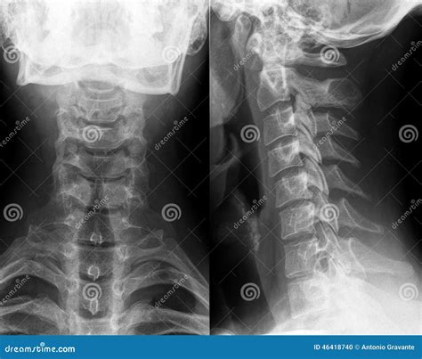 脖子和子宫颈脊椎x 射线 库存照片 图片 包括有 光盘 检查 照片 医学 子宫颈 患者 考试 46418740