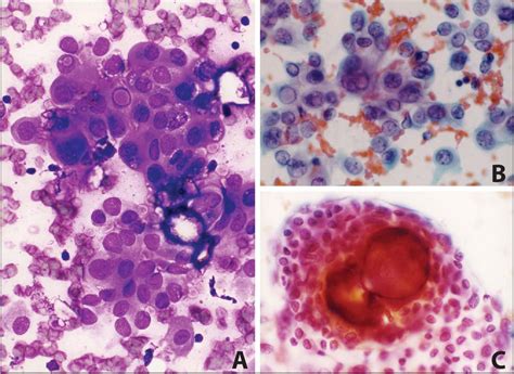 Figure 1 From Diagnosis Of Papillary Thyroid Carcinoma In Fine Needle Aspiration Smears