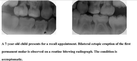 Pdf Ectopic Eruption Of The Maxillary First Permanent Molar Semantic Scholar