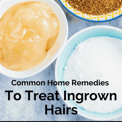 24 Home Remedies To Treat And Prevent Ingrown Hairs In 2021 Ingrown