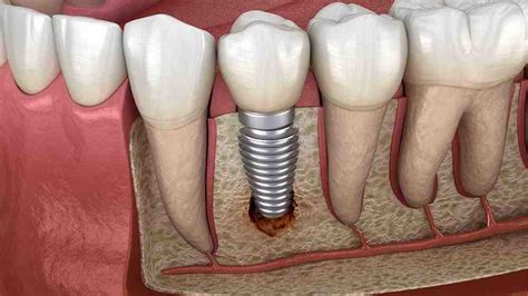 How Much Does It Cost To Put A Crown Over A Dental Implant Dental