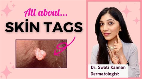 Skin Tags Causes Myths And The Best Removal Methods Explained By A