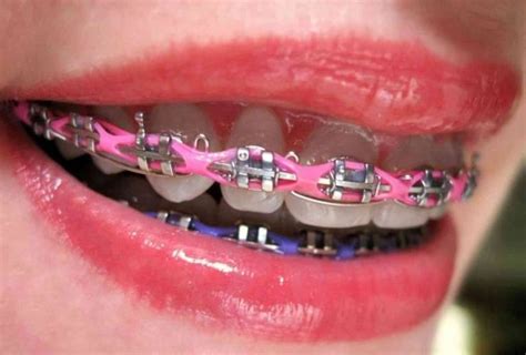 Ideas Para Combinar Los Colores De Los Brackets