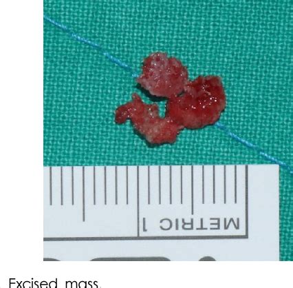 Figure From Intraosseous Hemangioma Of The Zygoma A Case Report