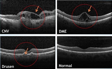 Normal Macular Oct