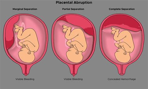 Placental Abruption Ultrasound Diagnosis