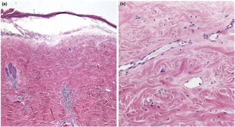 Histology of bullous morphea showing (a) Subepidermal blister with ...